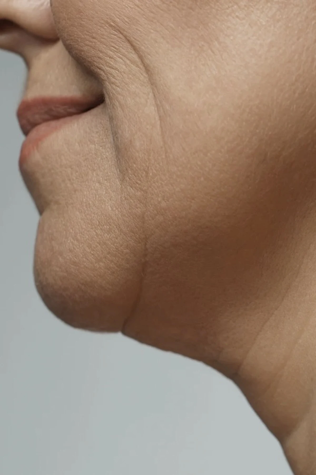 Lipolítico Facial